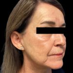 Facelift Before & After Patient #6094