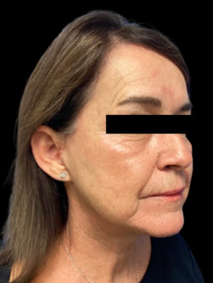Facelift Before & After Patient #6094