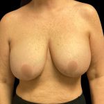 Breast Reduction Before & After Patient #5998