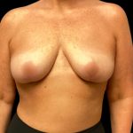 Breast Reduction Before & After Patient #5998
