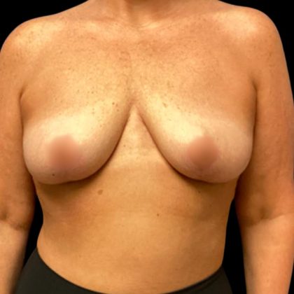 Breast Reduction Before & After Patient #5998