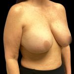 Breast Reduction Before & After Patient #5998