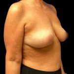 Breast Reduction Before & After Patient #5998