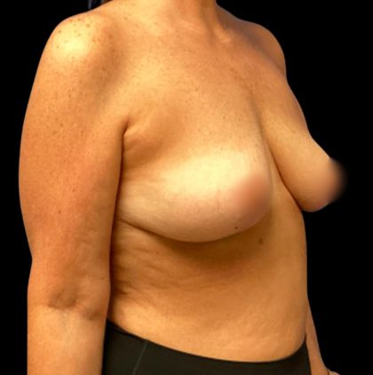 Breast Reduction Before & After Patient #5998