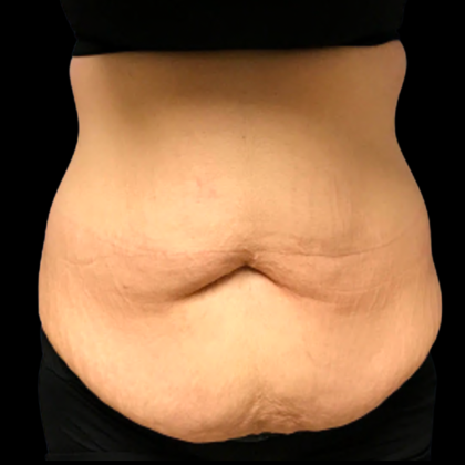 Tummy Tuck Before & After Patient #6154
