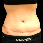 Tummy Tuck Before & After Patient #6154