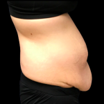 Tummy Tuck Before & After Patient #6154
