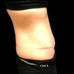 Tummy Tuck Before & After Patient #6154