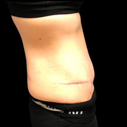 Tummy Tuck Before & After Patient #6154