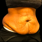 Tummy Tuck Before & After Patient #6155