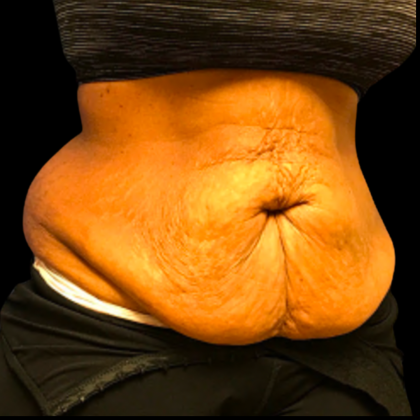 Tummy Tuck Before & After Patient #6155