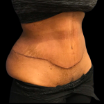 Tummy Tuck Before & After Patient #6155