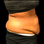 Tummy Tuck Before & After Patient #6155