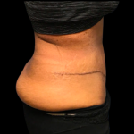 Tummy Tuck Before & After Patient #6155