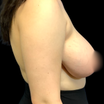 Breast Reduction Before & After Patient #6128
