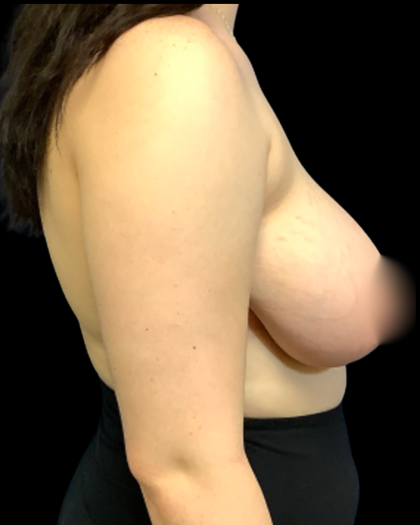 Breast Reduction Before & After Patient #6128