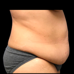 Tummy Tuck Before & After Patient #6156