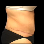 Tummy Tuck Before & After Patient #6156