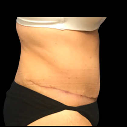 Tummy Tuck Before & After Patient #6156