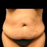 Tummy Tuck Before & After Patient #6156