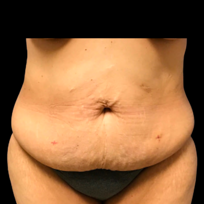 Tummy Tuck Before & After Patient #6156