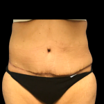 Tummy Tuck Before & After Patient #6156