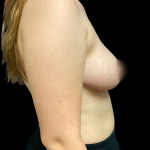 Breast Reduction Before & After Patient #6128