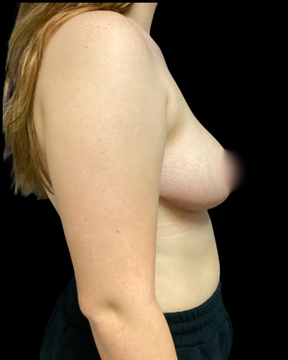 Breast Reduction Before & After Patient #6128