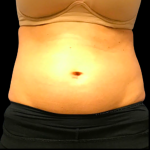 Tummy Tuck Before & After Patient #6157