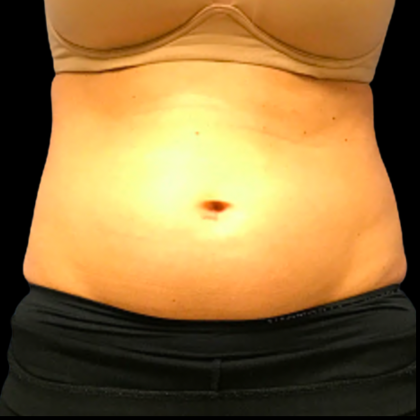 Tummy Tuck Before & After Patient #6157