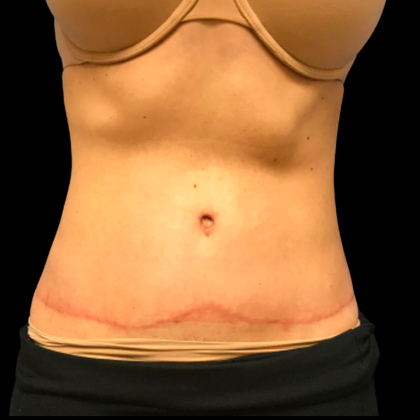 Tummy Tuck Before & After Patient #6157