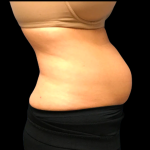 Tummy Tuck Before & After Patient #6157