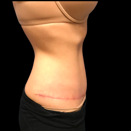 Tummy Tuck Before & After Patient #6157