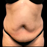 Tummy Tuck Before & After Patient #6158