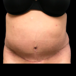 Tummy Tuck Before & After Patient #6158
