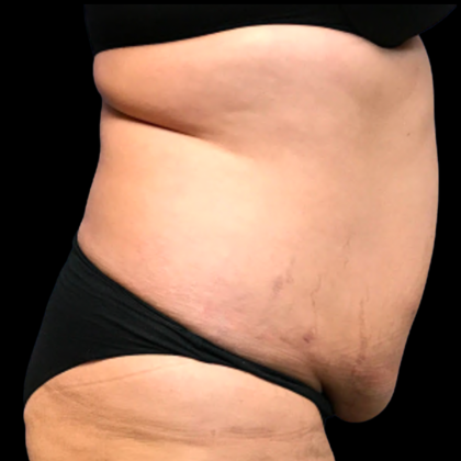 Tummy Tuck Before & After Patient #6158