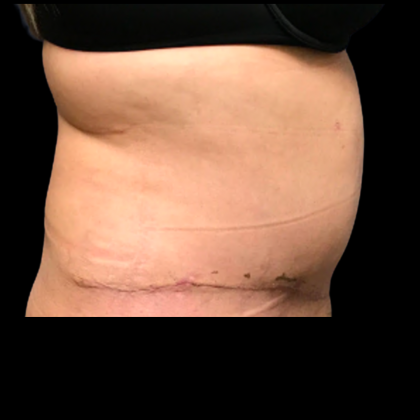Tummy Tuck Before & After Patient #6158