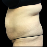 Tummy Tuck Before & After Patient #6159