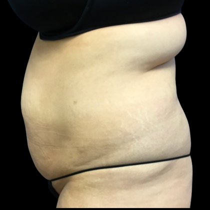 Tummy Tuck Before & After Patient #6159