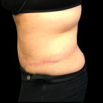 Tummy Tuck Before & After Patient #6159