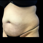 Tummy Tuck Before & After Patient #6159