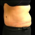 Tummy Tuck Before & After Patient #6159