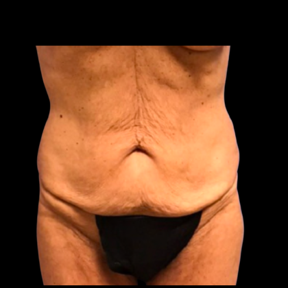 Tummy Tuck Before & After Patient #6160