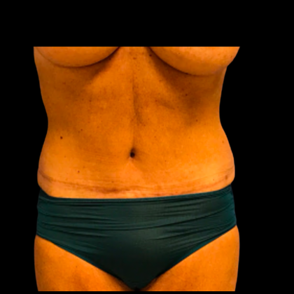 Tummy Tuck Before & After Patient #6160