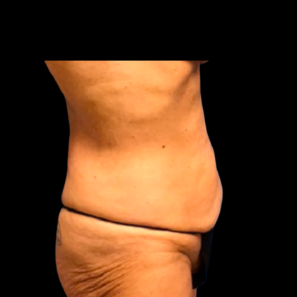 Tummy Tuck Before & After Patient #6160