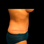 Tummy Tuck Before & After Patient #6160