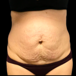 Tummy Tuck Before & After Patient #6161