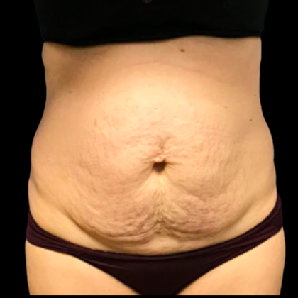 Tummy Tuck Before & After Patient #6161