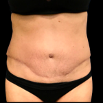 Tummy Tuck Before & After Patient #6161