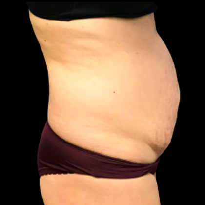 Tummy Tuck Before & After Patient #6161